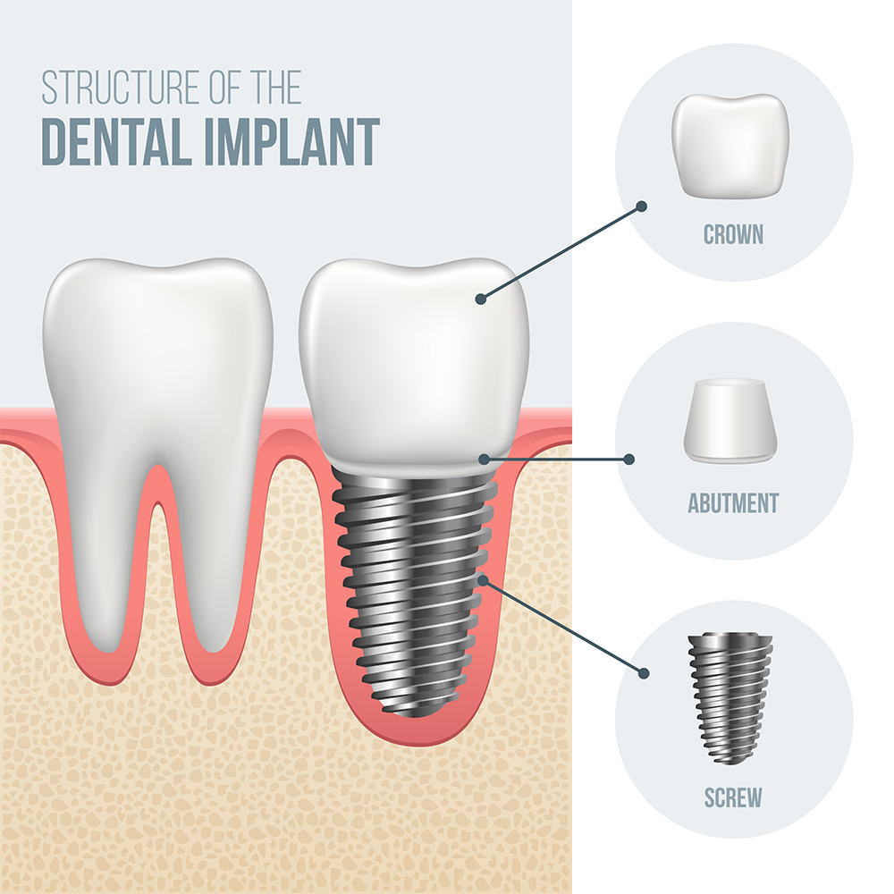 Illustration of the structures of Dental Implants, Muncie, IN